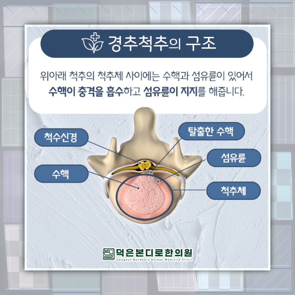 목디스크 초기 증상부터 비수술적 관리 방법 알아보기