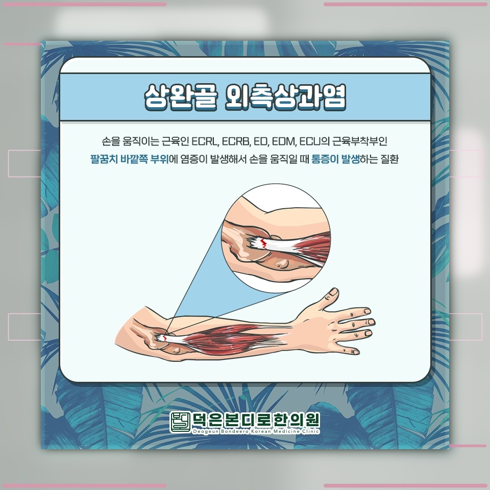 팔꿈치에 찌릿함이 반복될 때 살펴보는 테니스엘보