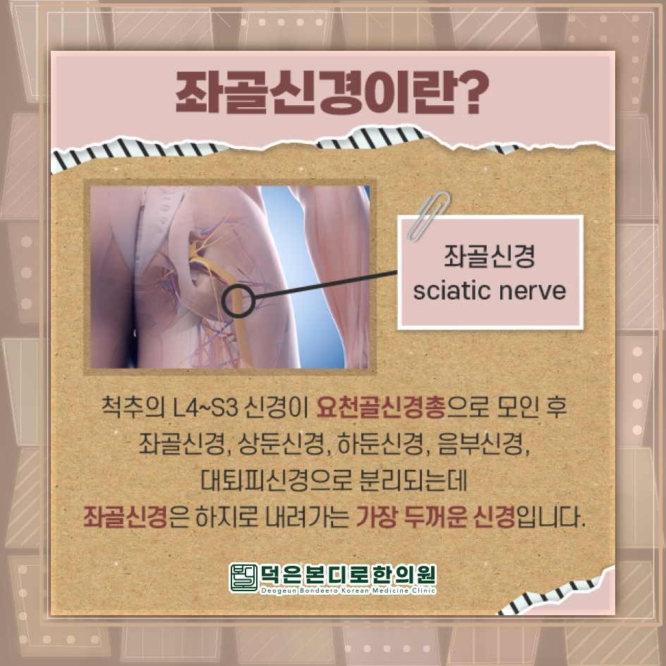 엉덩이부터 다리까지 이어지는 통증, 좌골신경통과 이상근증후군 구분하기
