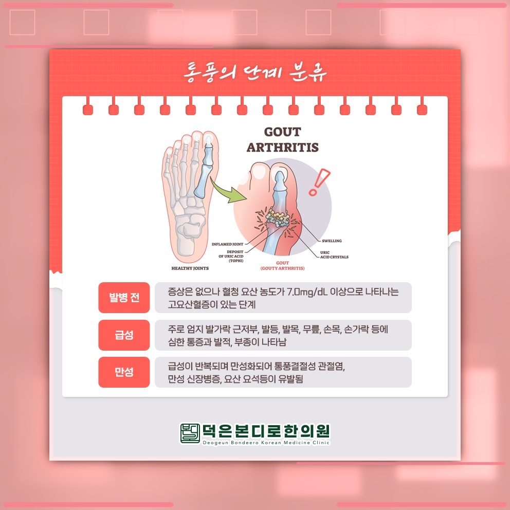 요산 결정으로 나타나는 통풍, 일상에서의 대처법