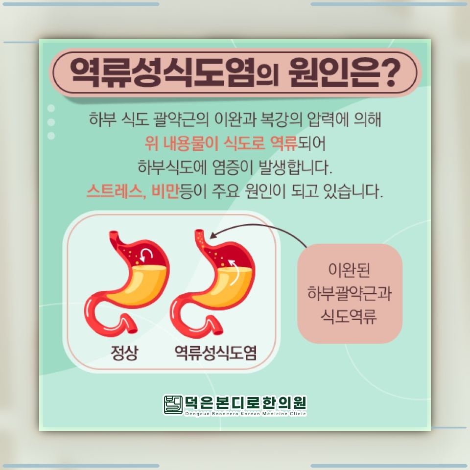 가슴이 타는 듯한 속쓰림, 역류성식도염에서 나타나는 이유